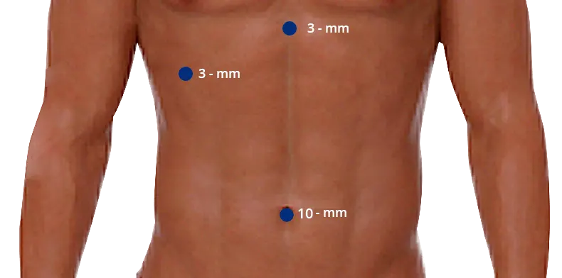3-Port Laparoscopic Cholecystectomy image